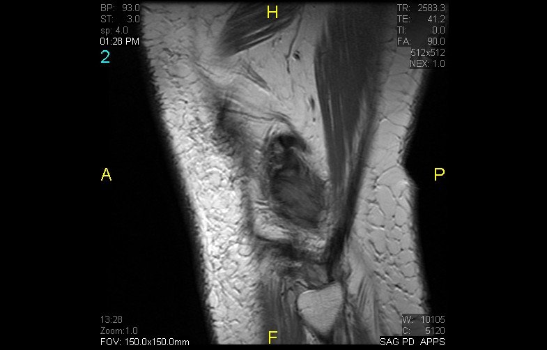 Figure 2 for case Popliteus tendinosis